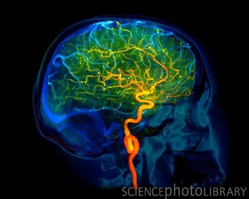 C0071980-Brain_blood_vessels,_3D_angiogram-SPL.jpg