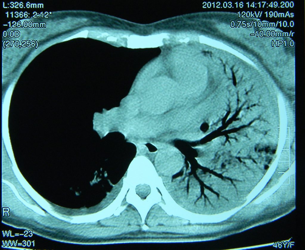 Imagem tomográfica mostrando broncogramas aéreos em uma tomografia