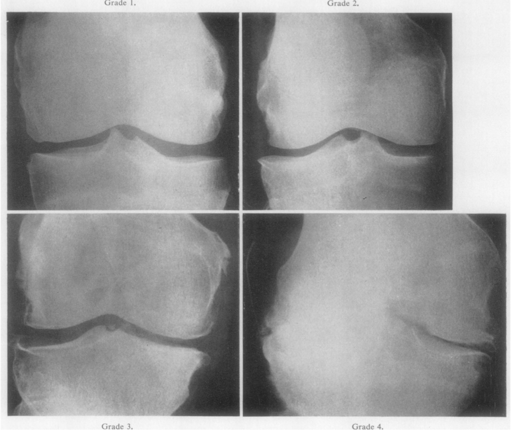 Classificação de Kellgren e Lawrence com a evolução radiografica da artrose de joelho.