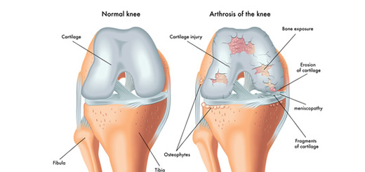 tratament mucosat articular